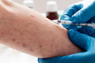 Puebla confirmó su primer caso de sarampión el pasado sábado 17 de enero de 2026